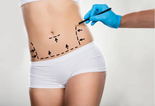 Abdomen femenino con marcas prequirúrgicas para abdominoplastia, cirugía plástica en Cartagena.
