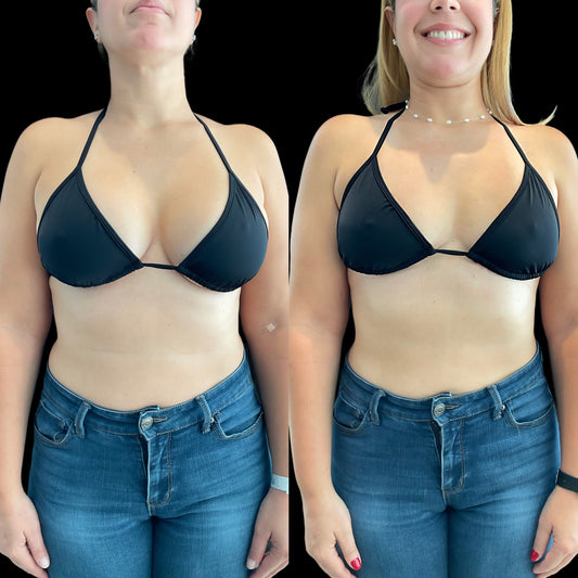 Explantación mamaria en Bogotá y Cartagena: precio, capsulectomía y recuperación