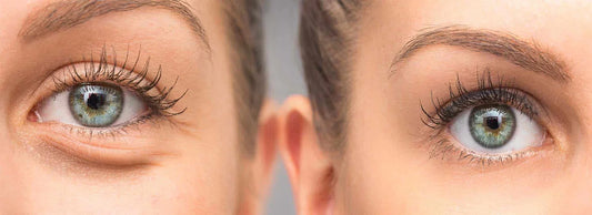 Antes y después de blefaroplastia en párpados, cirugía estética Doctor Puello Cartagena Bogotá